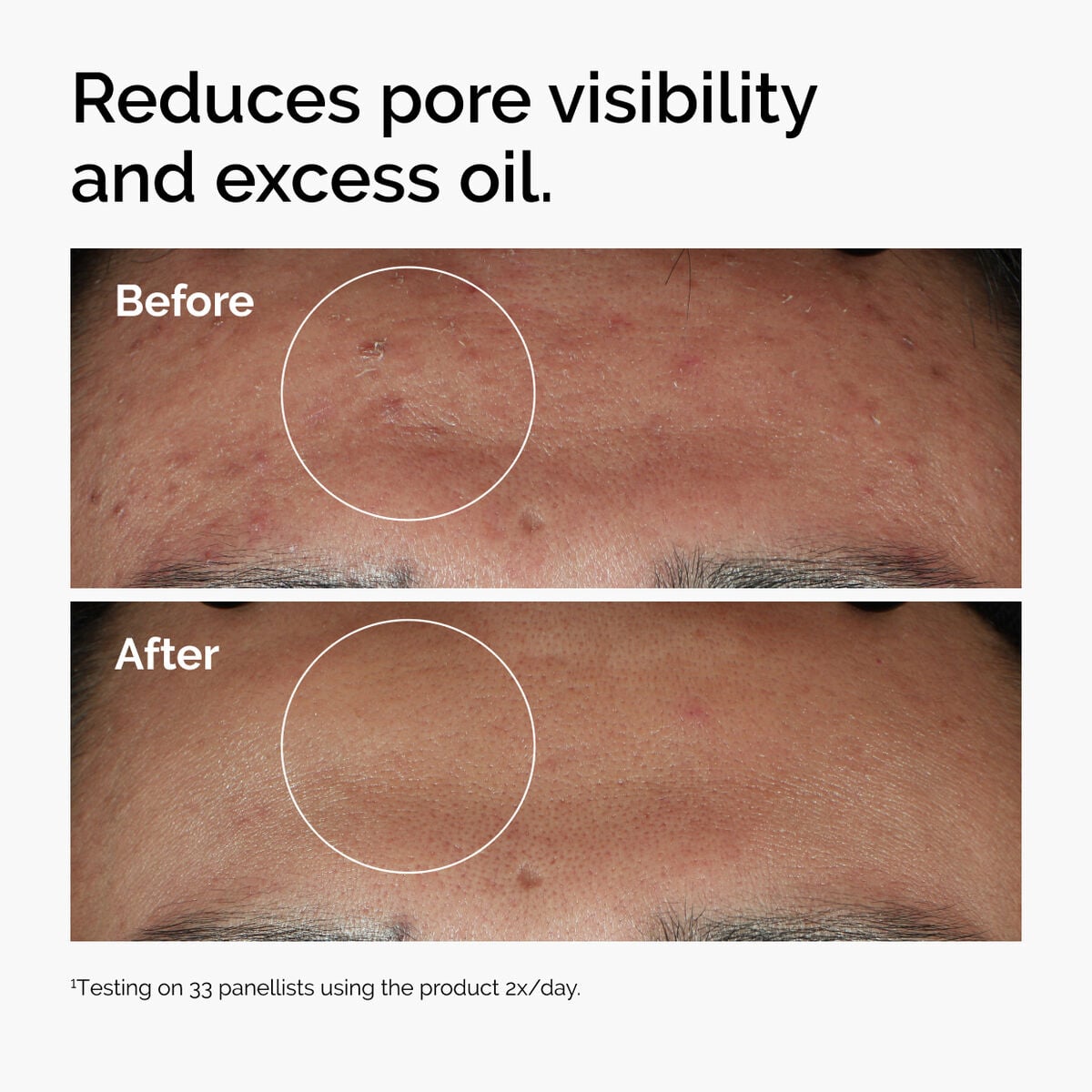 Before and after using Niacinamide 10% + Zinc 1%  to reduce oil and minimize pores.